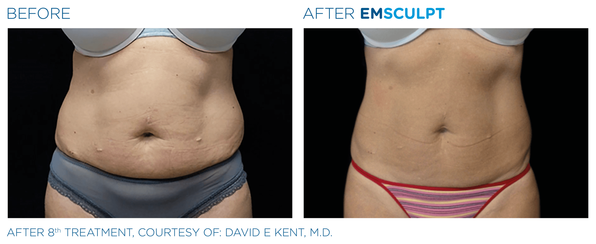 Understand the key differences between CoolSculpting and EMSCULPT for effective fat reduction and muscle toning.