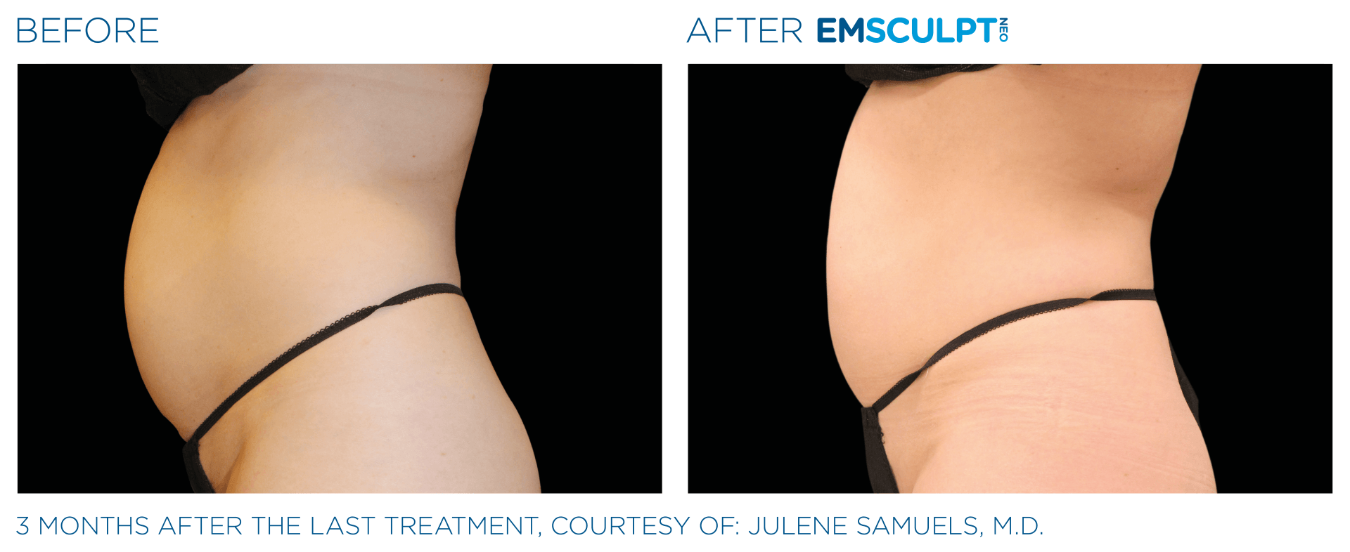 Try EmSculpt free trials in Westerville, Ohio, to sculpt your dream body with advanced treatments.