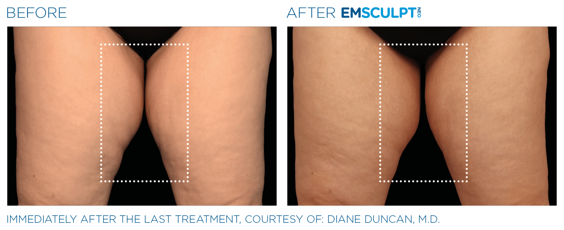 EmSculpt NEO: The ultimate solution for simultaneous muscle toning and fat reduction in Westerville.
