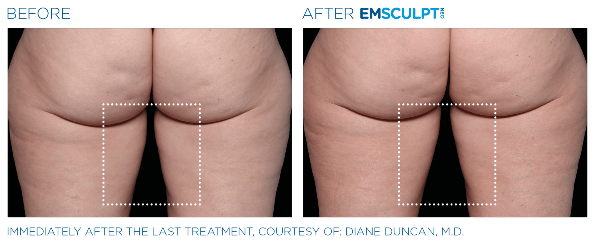Lift and tone your bottom with EMSCULPT  in Westerville, OH. FREE trial!