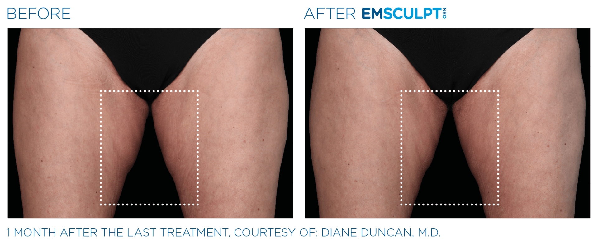 EmSculpt NEO: The ultimate solution for simultaneous burning fat and building muscle tone. 