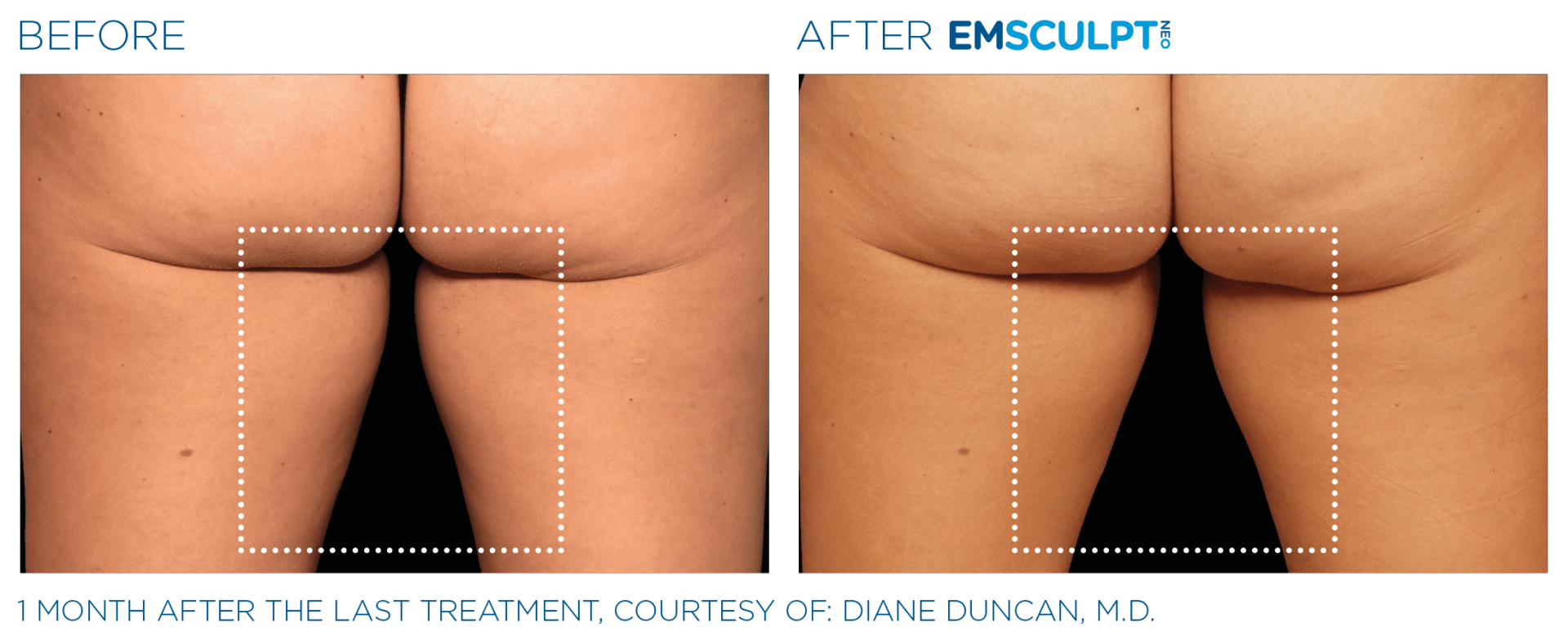 EmSculpt NEO: The ultimate solution for inner thigh toning and fat reduction in Westerville, OH.