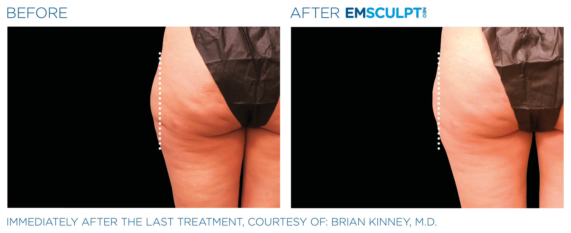 Side thigh results with Emsculpt neo at Dr. Mantor's Wrinkle and Weight Solutions in Westerville, OH book your free trial today!