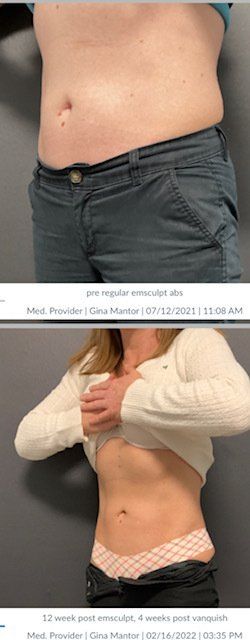 Want toned muscles or a slimmer figure? EmSculpt NEO does both. Try it in Westerville, OH!