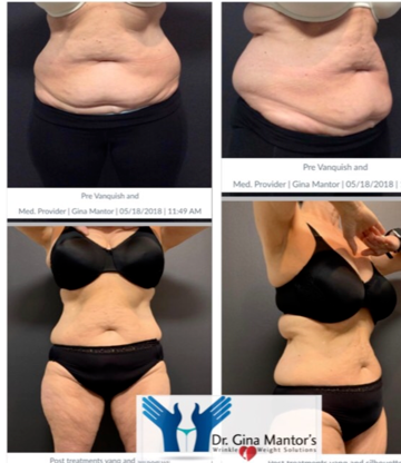 Achieve your dream body safely. Try Emsculpt, the non-invasive, FDA-cleared solution. Free trials available.