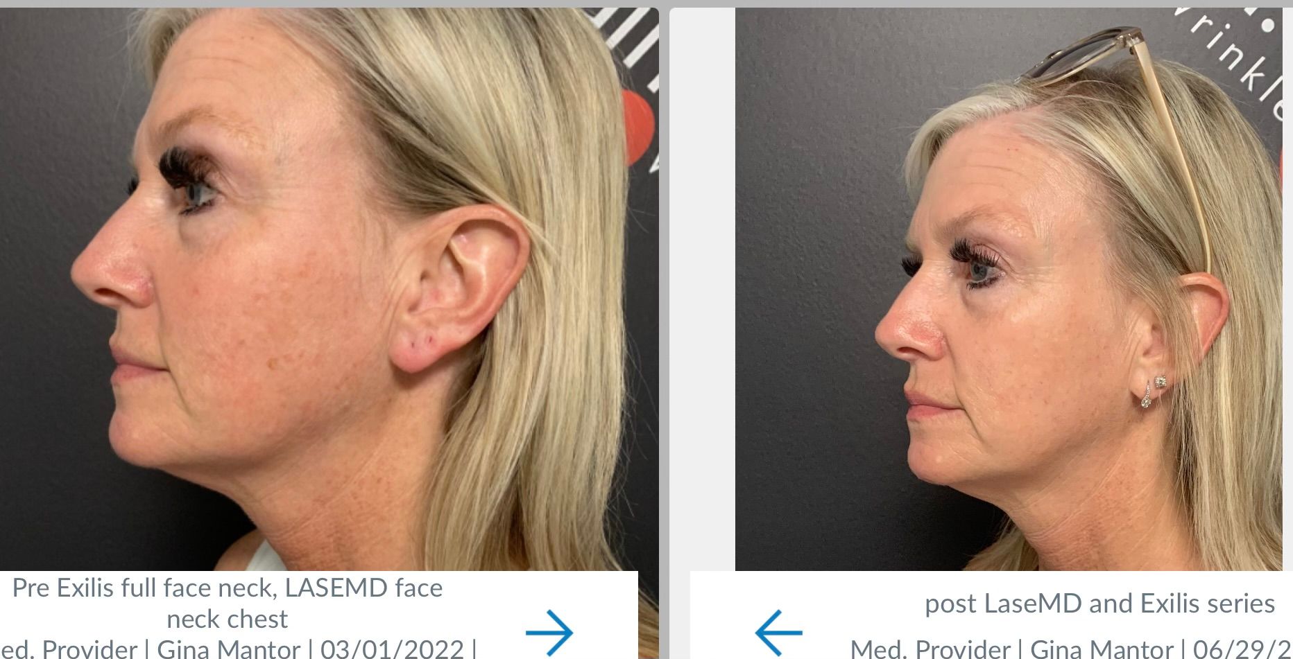 neck / submentum results with Exilis ultra 360 at Dr. Mantors - free conult
