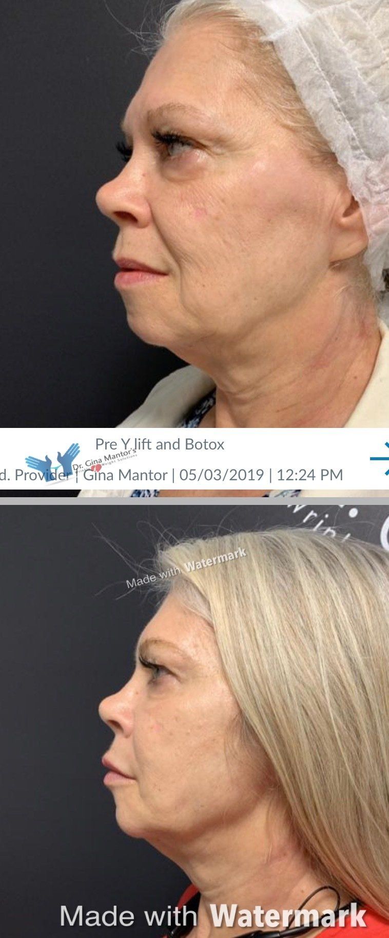 Micro-needling — Side View Before and After Lift in Columbus, OH
