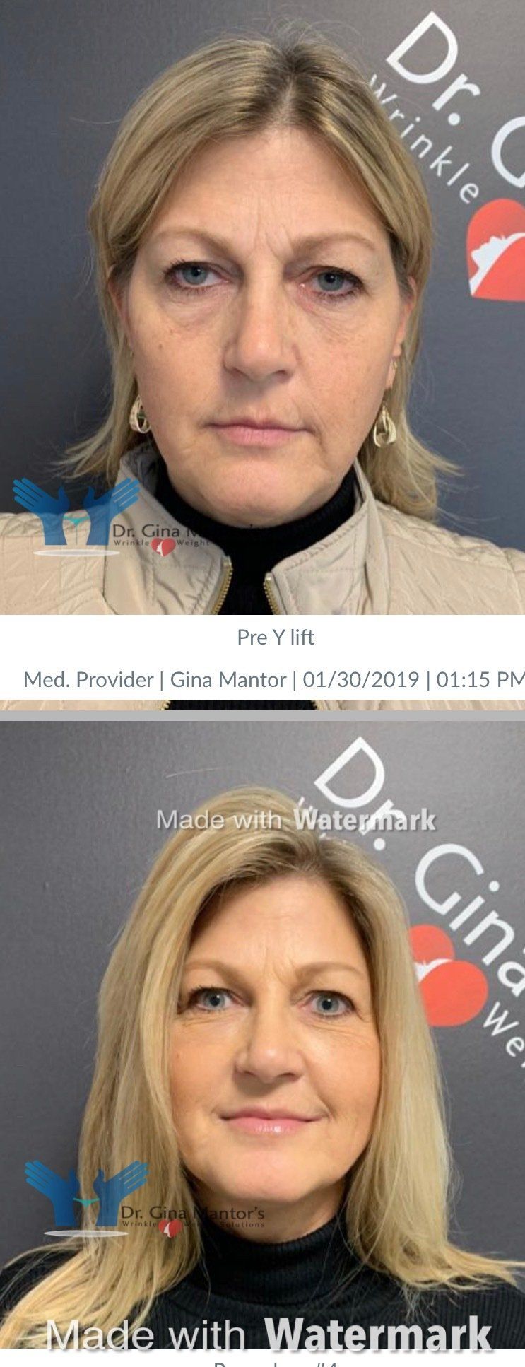 Voluma — Side View Before and After Pre-Lift in Columbus, OH