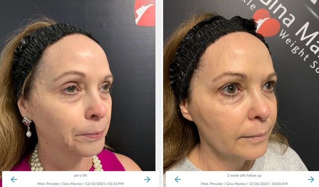 beautiful patient results with the Y-lift performed by Dr. Gina Mantor