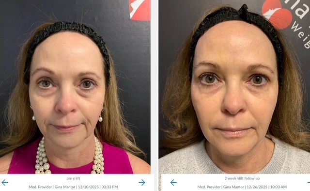 graphic of Wrinkle and Weight Solutions patient after the y-lift