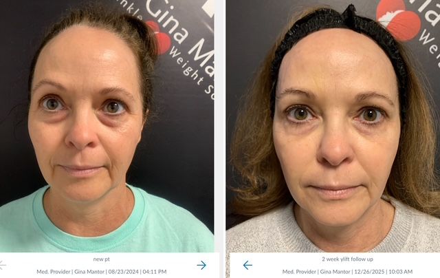 graphic of patient's results after y-lift treatment performed by Dr. Gina Mantor