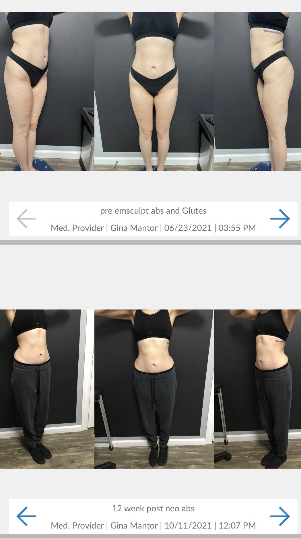 Pre Emsculpt Abs And Glutes - Columbus, OH - Dr. Mantor's Wrinkle and Weight Solutions