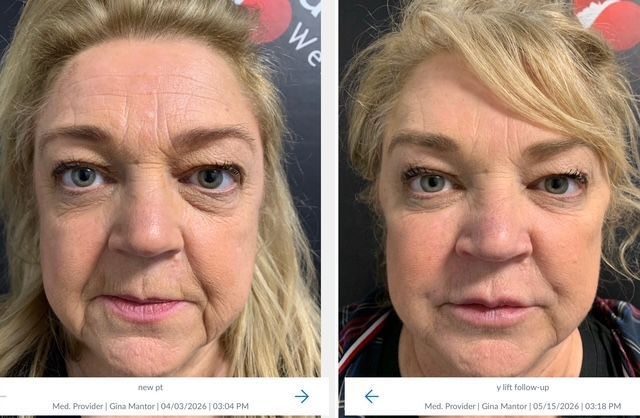 non-surgical facelift the Y-lift, no incisions, quick results by Dr. Mantor