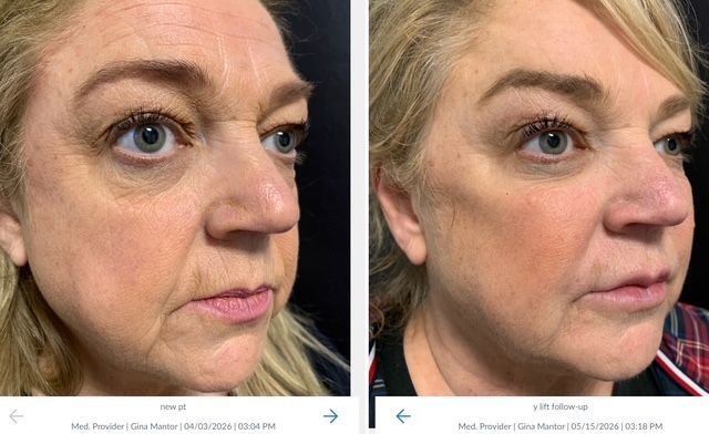 patient rsults 2 weeks after Y-lift performed by MD injector Dr. Gina MAntor