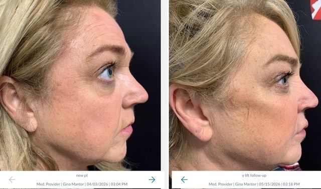 cheek bones and youthful patient results by Dr. Gina Mantor MD injector 