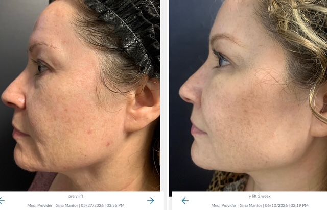 profile results of the Y-Lift performed by Dr. Gina Mantor in Westerville