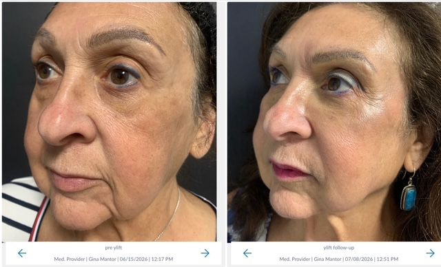 72 year old patient y-lift results - no stitches or downtime
