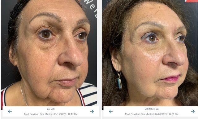 patients results on 72 year old female at Wrinkle and Weight solutions