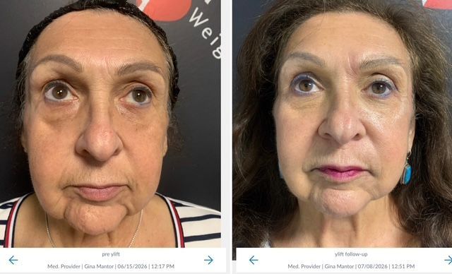 y-lift results performed by Dr. gina Mantor - patient frontal view