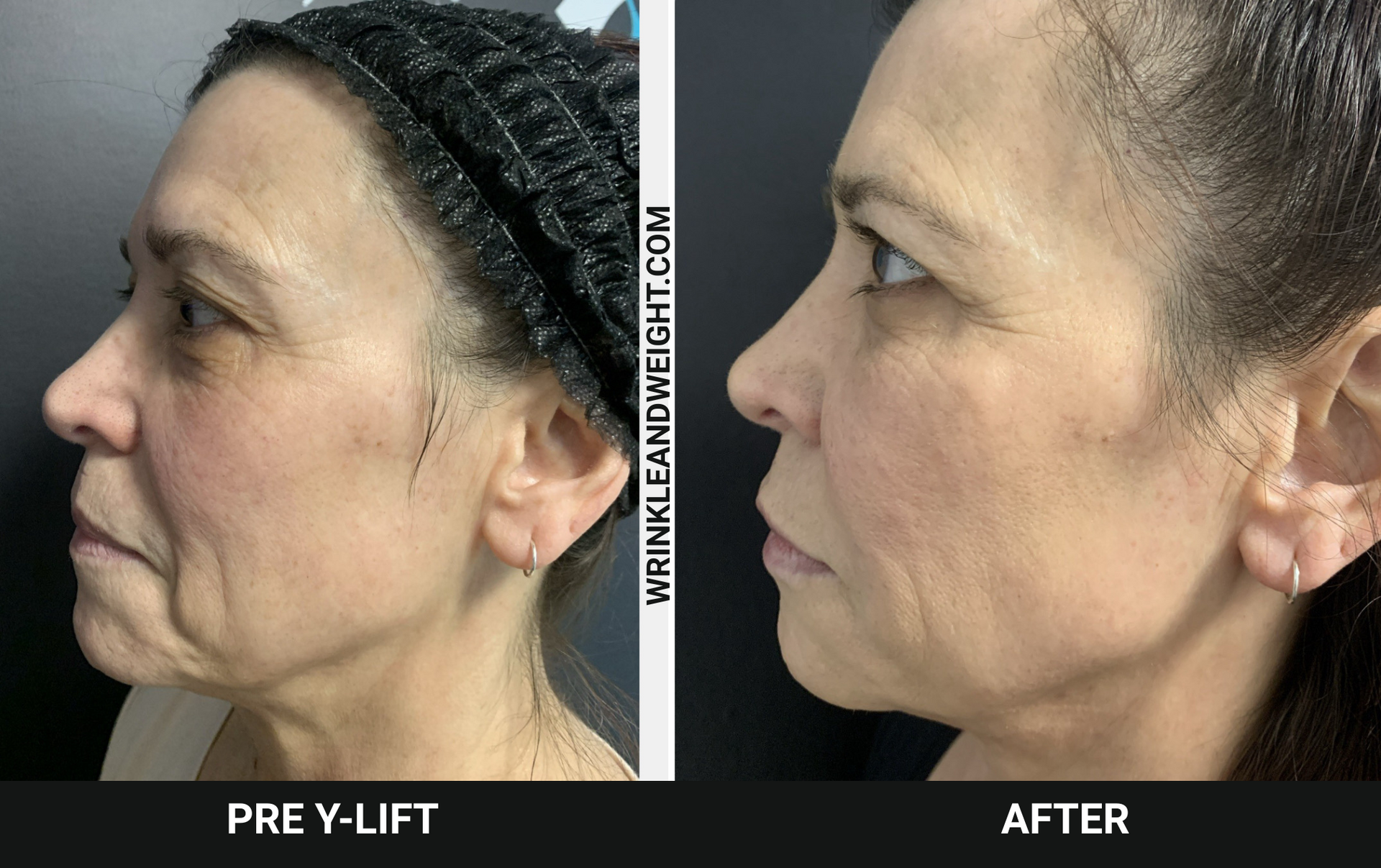 Patient looks refreshed, skin has more tone and lift at WrinkleandWeight.com