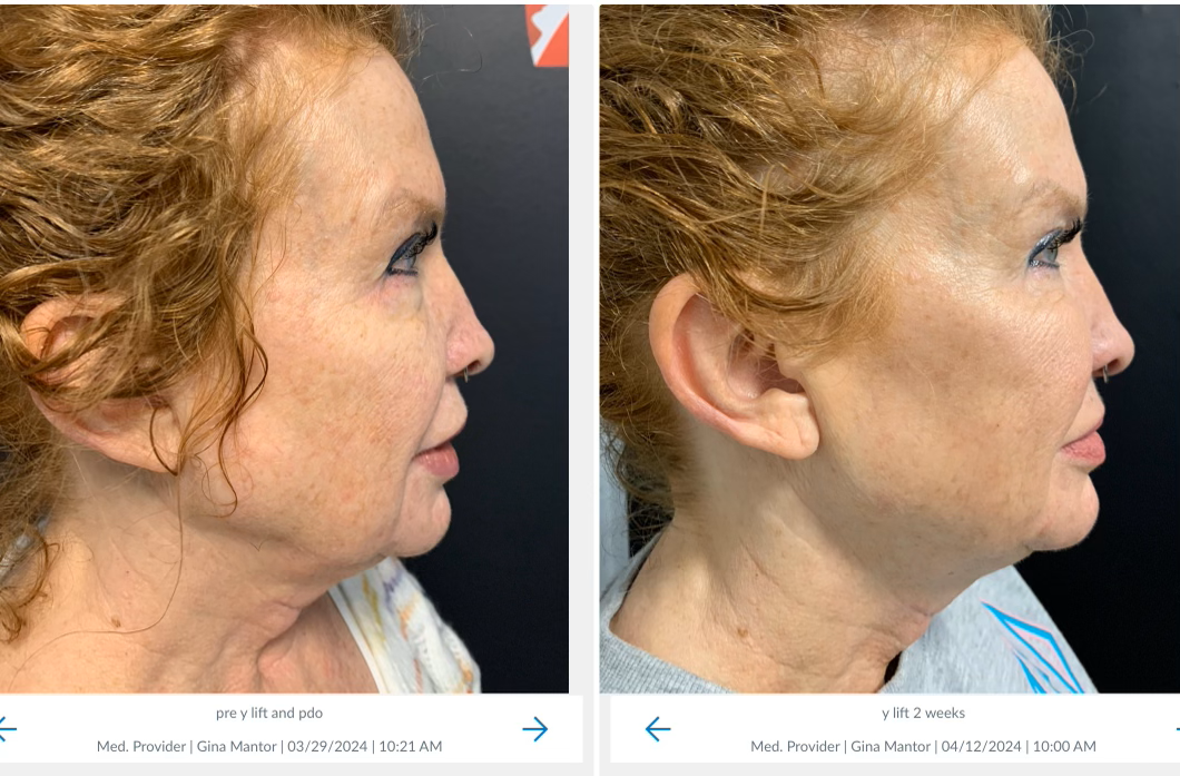 Thread lift results in combination with a Y-Lift preformed by Double-Board certified Physician, Dr. Gina Mantor in Westerville, OH