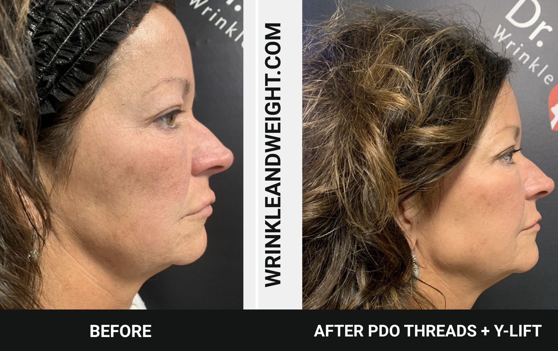
Amazing results with PDO Thread Jaw Line Loft plus Y-Lift performed by Dr. Gina Mantor