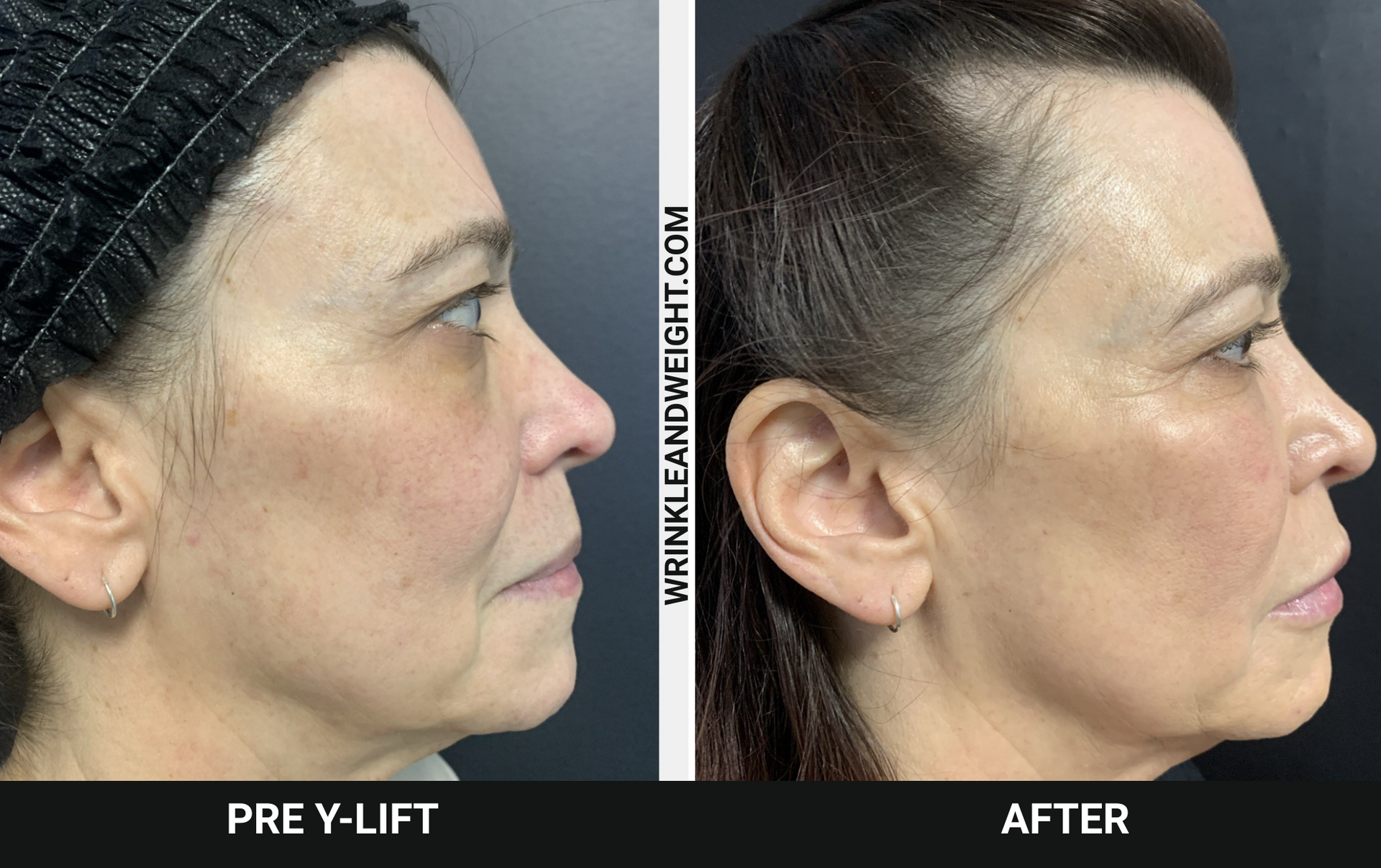 Dr. Gina Mantor's patient's before and after the Y-Lift! FREE MD consults!