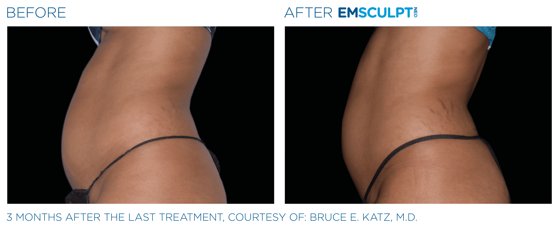 Achieve muscle toning and fat reduction with EmSculpt NEO in Westerville, Ohio. Book your free trial now!