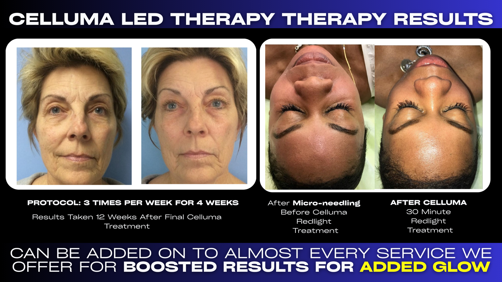 Redefine Radiance: Boost Skin Health with LED Light Therapy at our Westerville Medspa