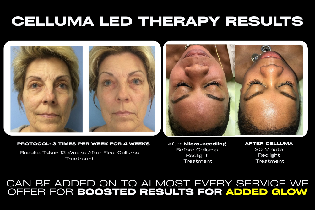 LEDLight therapy with Celluma at Dr. Mantor's Wrinkle and Weight Solutions