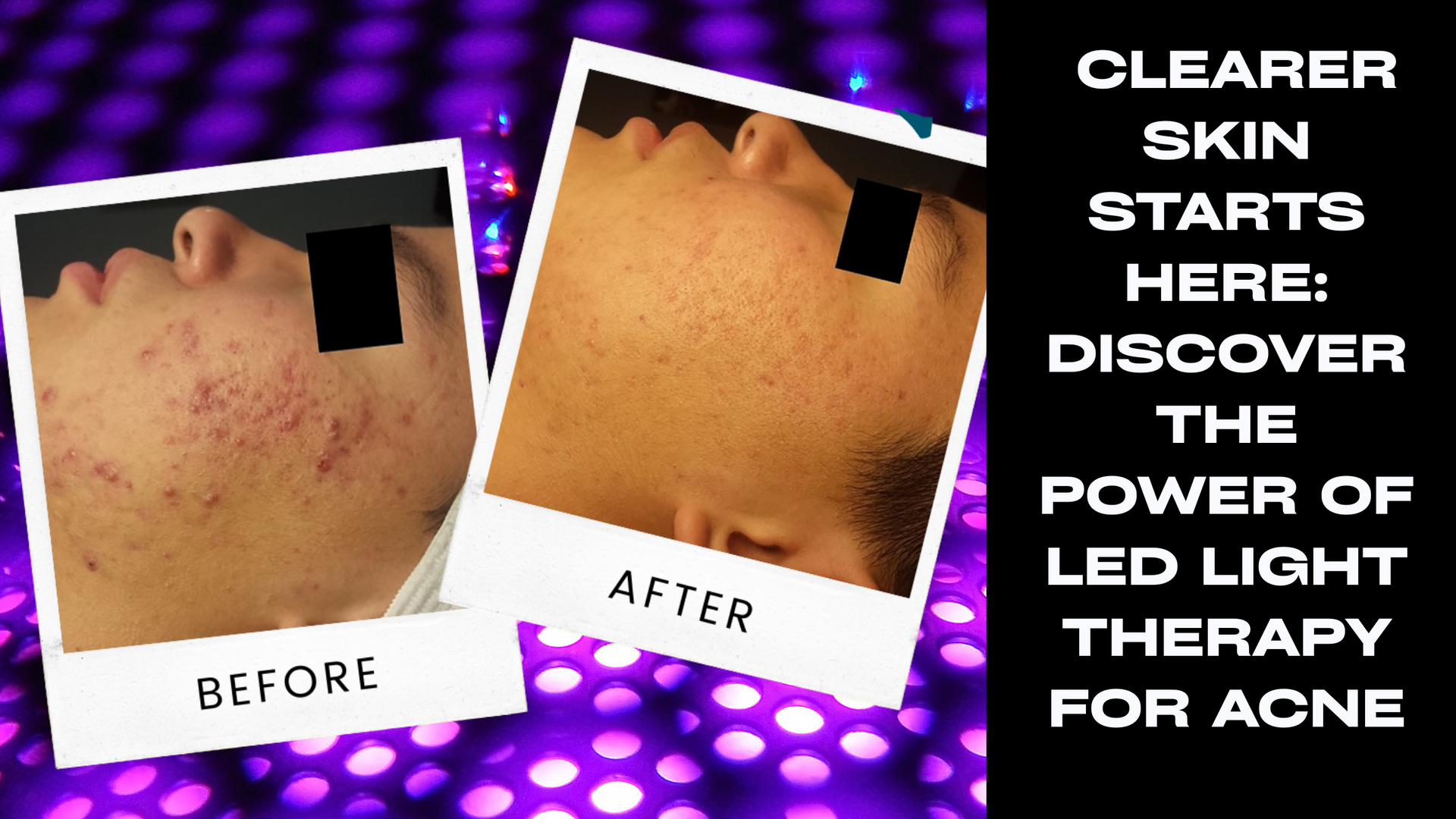 LED Light therapy for acne...experience less acne and smooth skin non-invasively