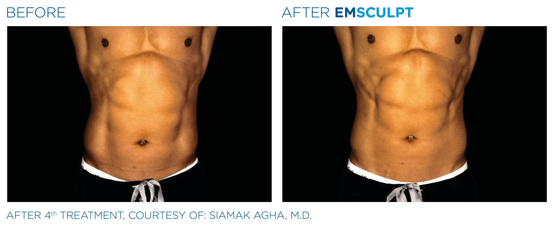 See real results with Emsculpt Neo for fat loss and muscle gain. Free trial at Dr. Mantor's!