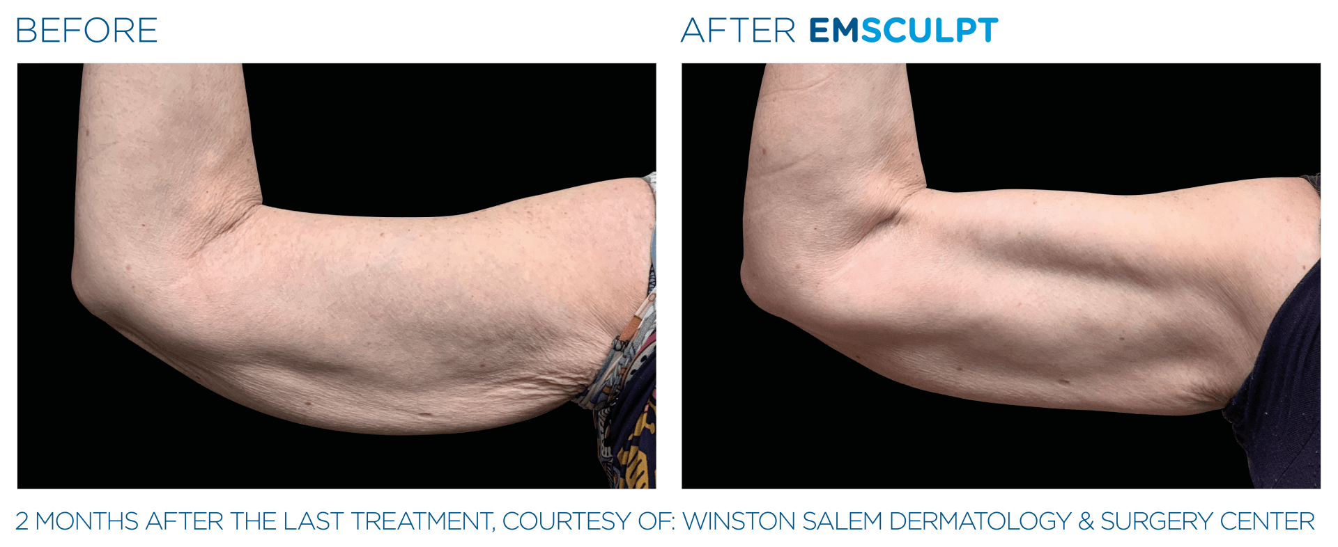 Emsculpt NEO. Because who needs bicep curls when you can zap your fat away? Try it for free!