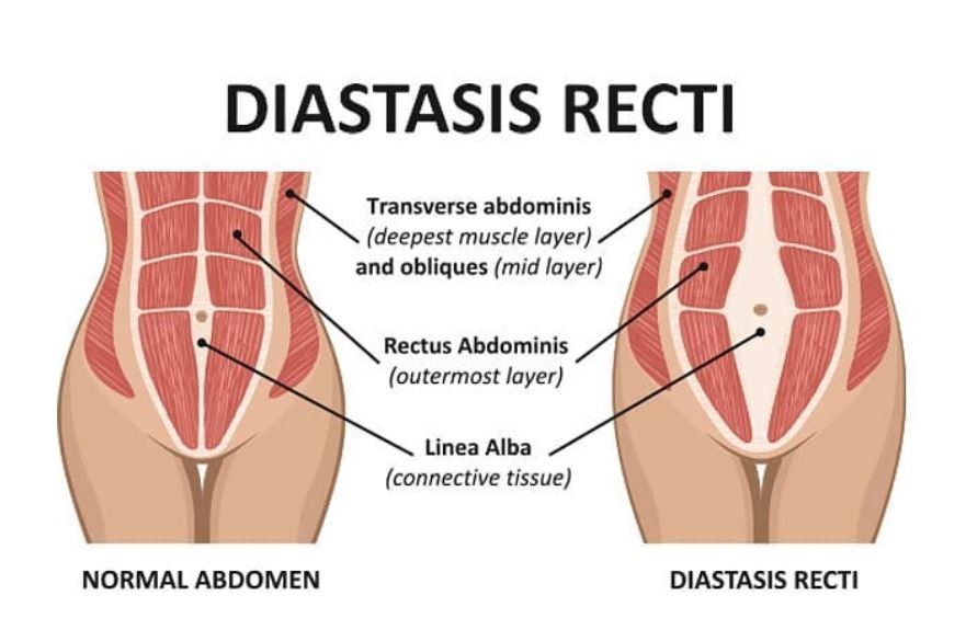Diastasis Recti - What Is It? – Mommy Matters