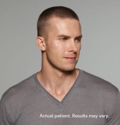 national botox day is for men too