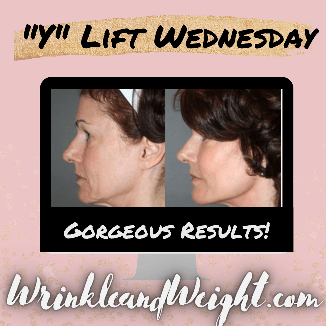 YLiftLiquid Facelift Procedure Columbus, OH Dr. Mantor's Wrinkle