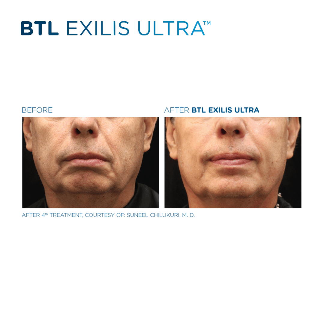 Skin Tightening with Exilis