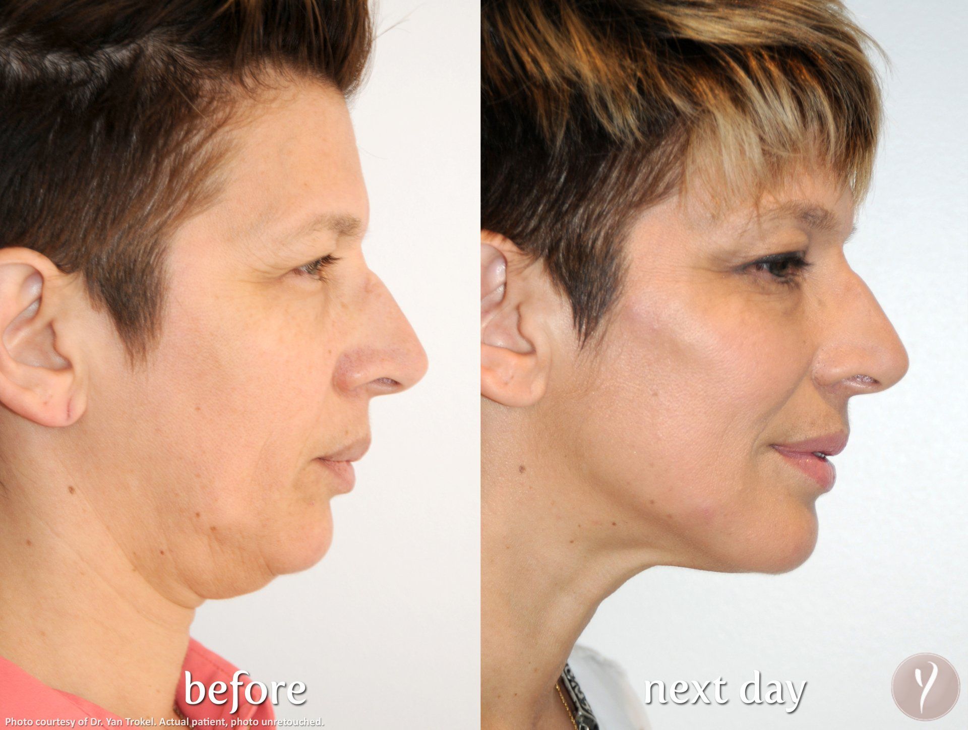 Get your cheekbones back from the abyss—no scalpels or anesthesia required. Instant jawline envy included!