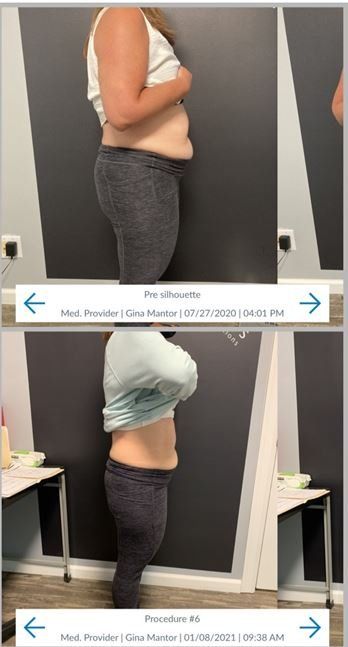 weight loss before and after  at Dr. Mantor's Wrinkle and Weight Solutions, LLC in Westerville, OH