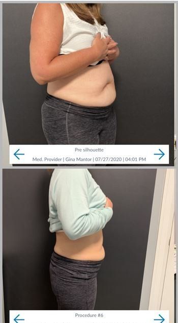 patient weight loss progress  at Dr. Mantor's Wrinkle and Weight Solutions, LLC in Westerville, OH