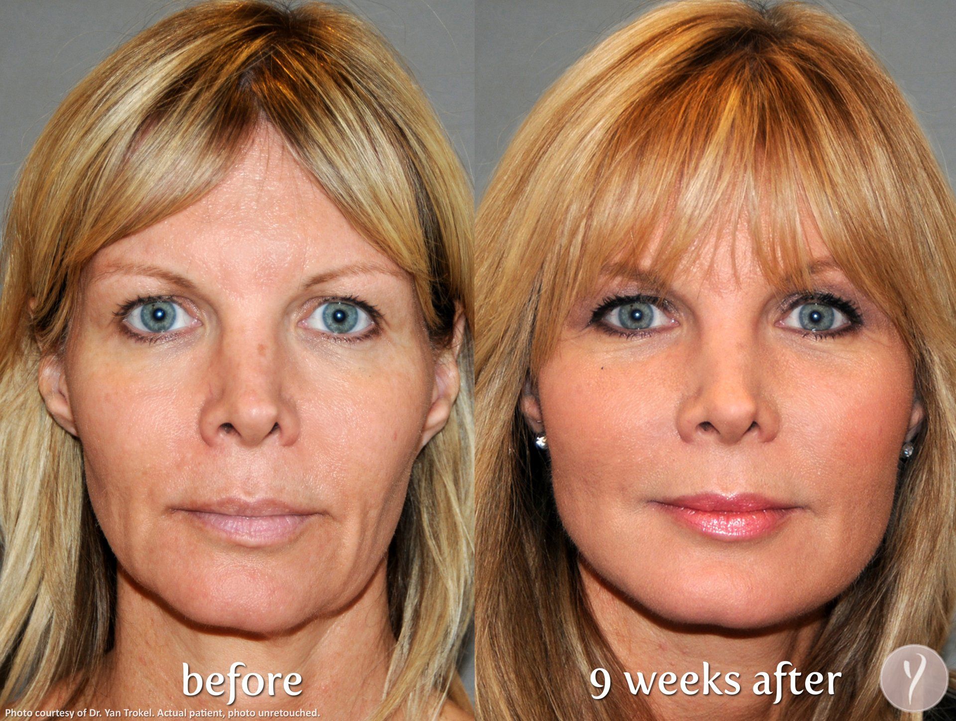 No downtime, no sugery just amaxing results with the y-lift
