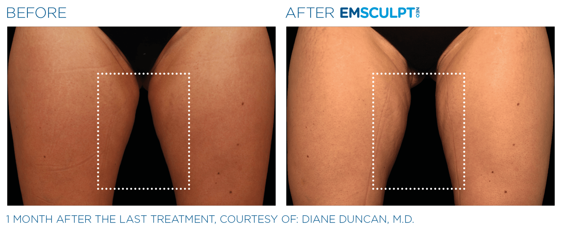 Try EmSculpt free trials in Westerville, Ohio, sculpt your dream body with advanced treatments today!