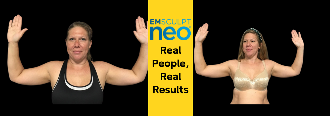 Arm results with Emsculpt neo at Dr. Mantor's Wrinkle and Weight Solutions in Westerville, OH book your free trial today!