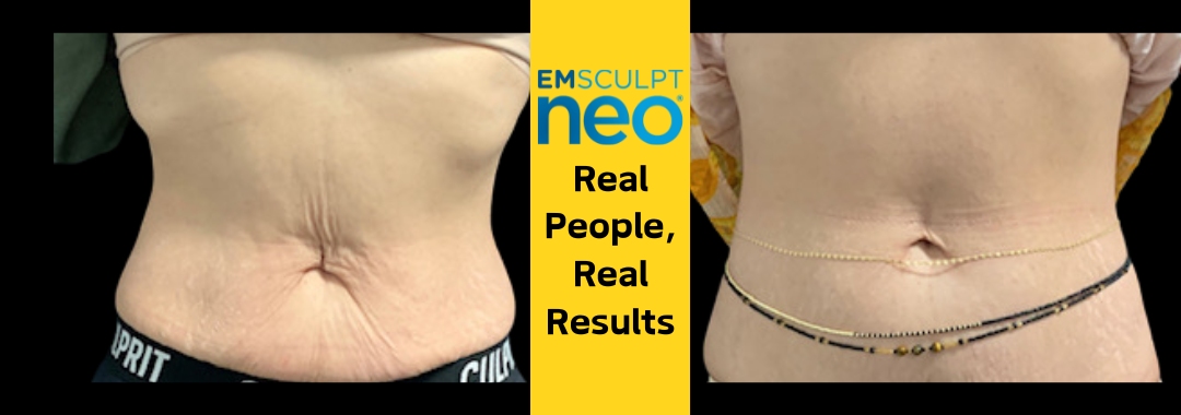 female belly results with Emsculpt neo at Dr. Mantor's Wrinkle and Weight Solutions in Westerville, OH book your free trial today!