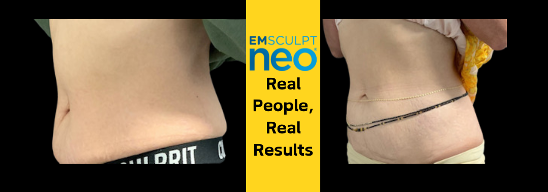 burn fat with with Emsculpt neo at Dr. Mantor's Wrinkle and Weight Solutions in Westerville, OH book your free trial today!