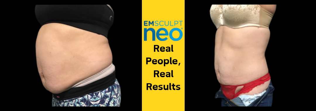 Female stomach results with Emsculpt neo at Dr. Mantor's Wrinkle and Weight Solutions in Westerville, OH book your free trial today!