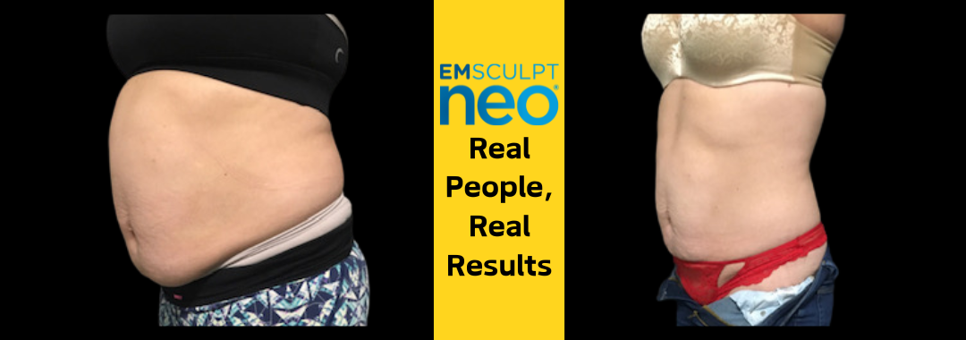 See stunning before and after results of Emsculpt NEO, the dual-action treatment for fat loss and muscle gain.