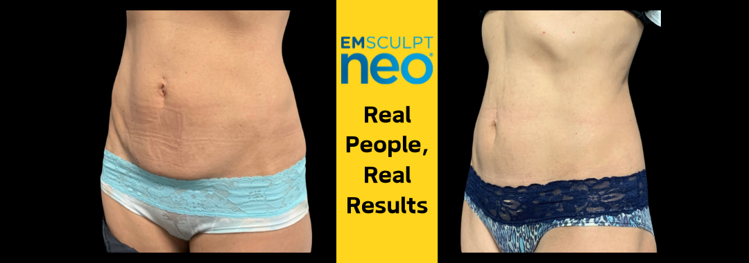 Tight stomach results with Emsculpt neo at Dr. Mantor's Wrinkle and Weight Solutions in Westerville, OH book your free trial today!