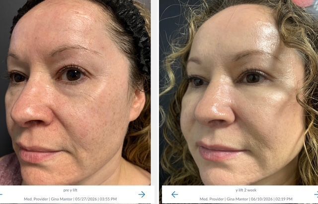 patient results by Dr. Gina Mantor - The Y-lift
