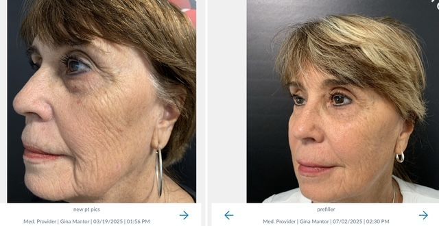 Dr. Gina Mantor's patients results after the Y-lift, non-surgical fac lift